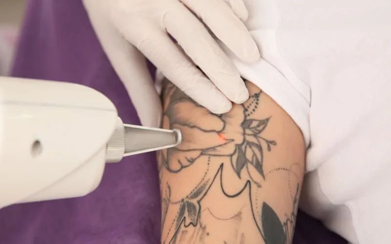 Can You Remove Only Part of a Tattoo?